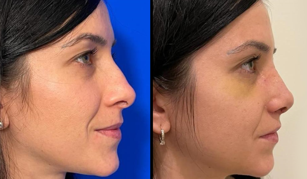 RHINOPLASTY