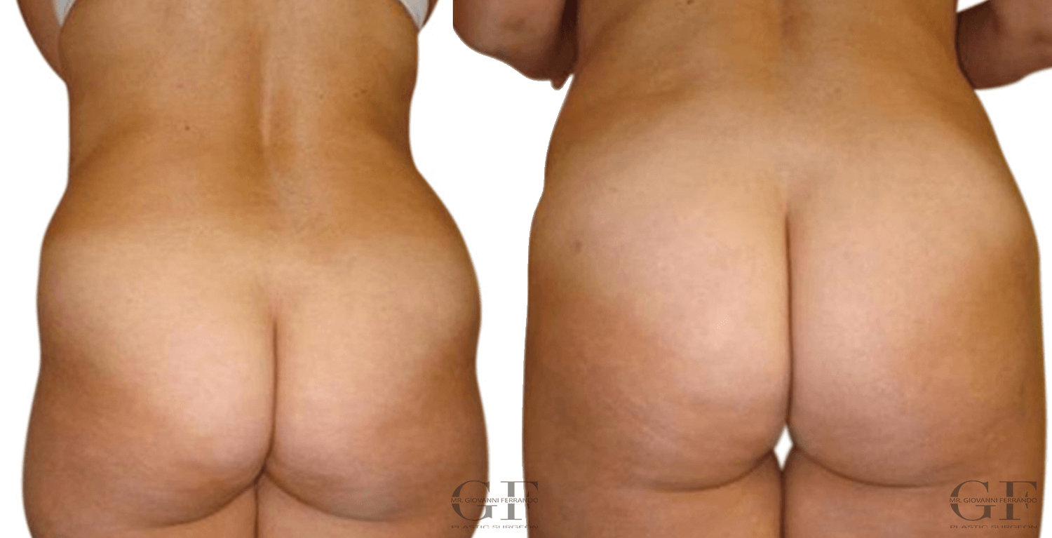 Liposuction body contouring by Dr. Giovanni Ferrando in London