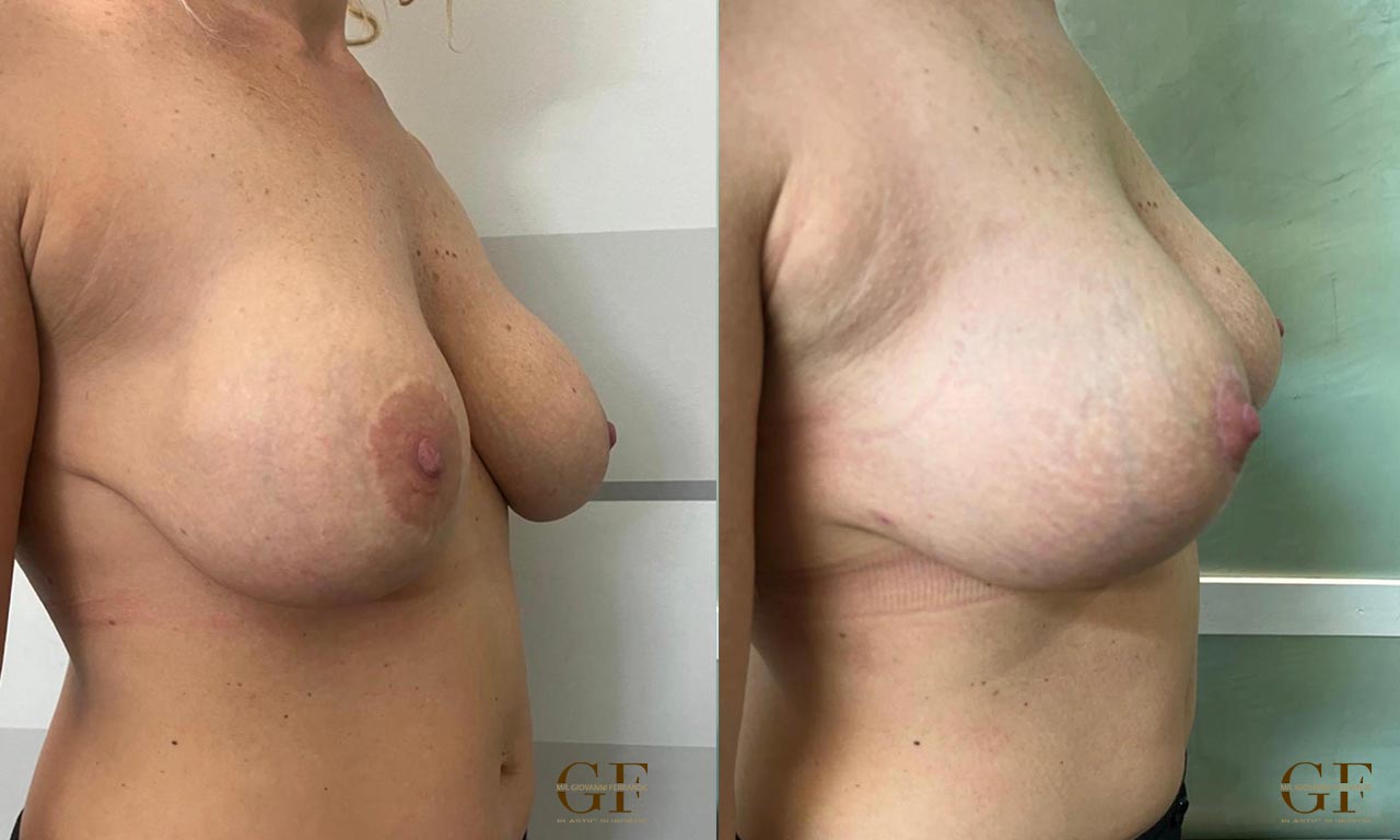 Breast augmentation surgery by Dr. Giovanni Ferrando — natural results